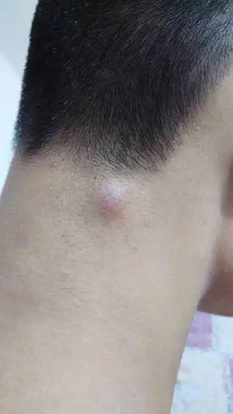 后脑勺长个大包,摸到是硬的,还疼,今晚上破了流的是黄色东西,,问问这