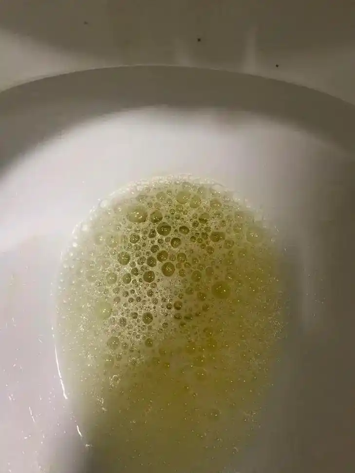 3方面辨别正常尿液与异常尿液.  总有肾友告诉我,我尿泡沫了 - 抖音