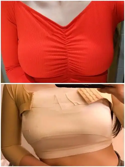 我是生完孩子,胸一下子瘪了的,之前虽然不大,但是好_圈子-新氧美容