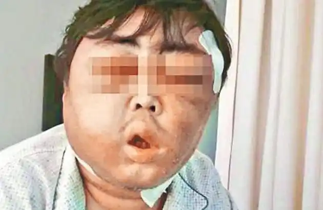 毒蚊叮咬 脸肿变猪头