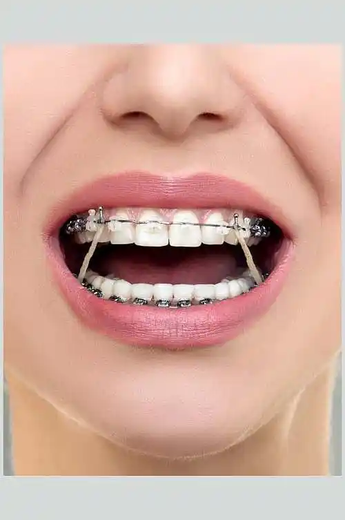 口腔健康牙套牙齿矫正图片