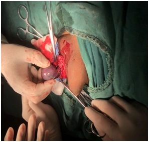 睾丸扭转病例分享