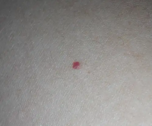 皮肤是有几个小红血点.请问这是怎么了?