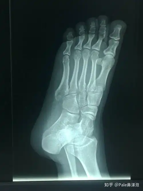 医生建议可以适当活动脚趾,用脚后跟着地借助外力逐渐走一走.