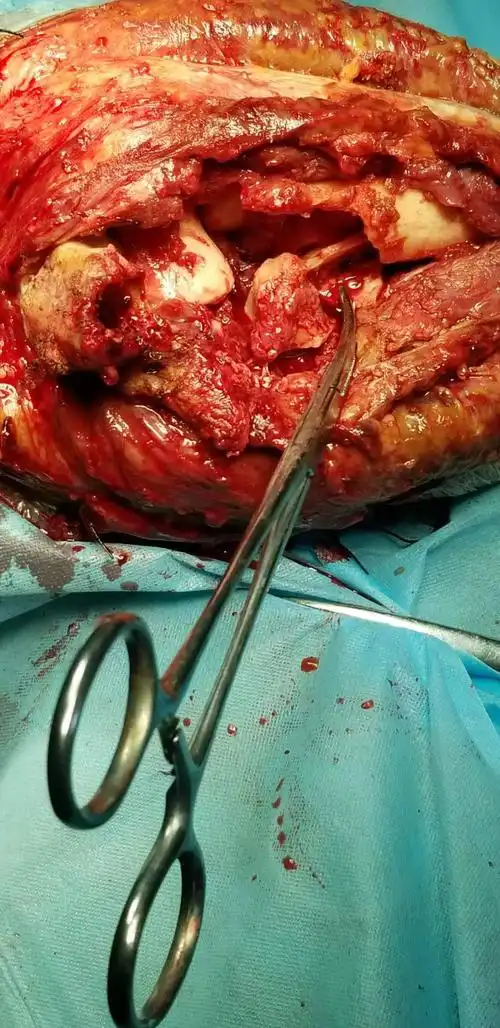 我院骨一科近期完成一例严重恐怖三联症手术