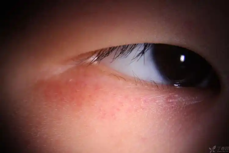 【眼整形讨论】眼睑成片红点是什么? [病例帖]