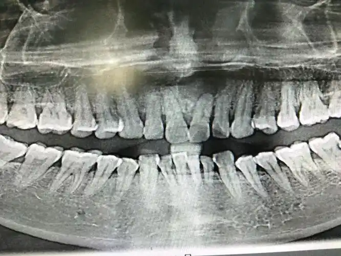 上前牙根尖囊肿手术(胆小勿入)