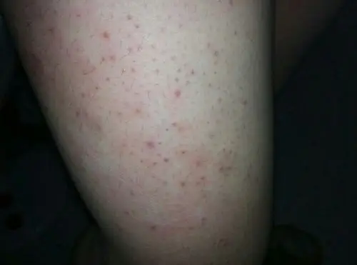 请问我大腿上的毛孔为什么会这样