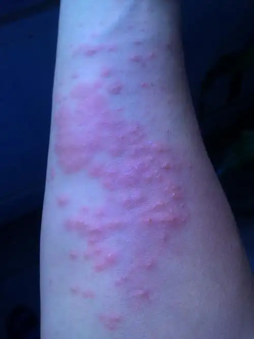 双手前肘出现红斑块 很痒 什么病