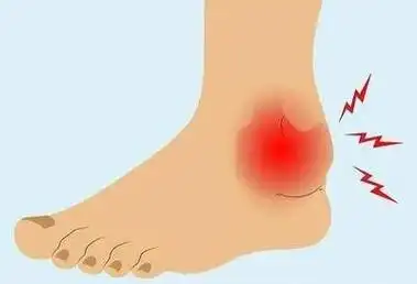 骨折|肿胀|关节囊|人工膝关节_网易订阅