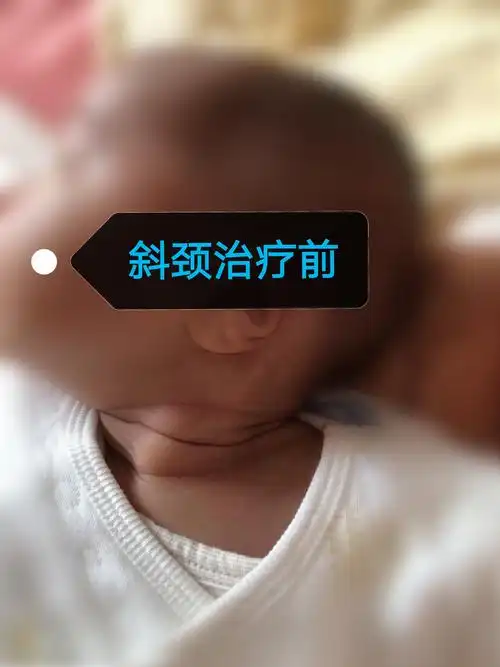 来自河南小陈先天斜颈巨大包块治愈案例分享 - 好大夫在线