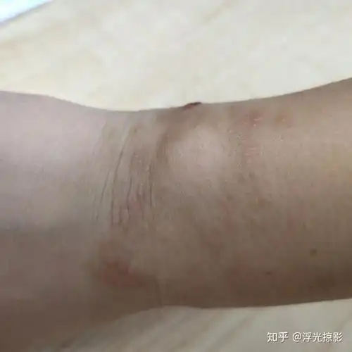 被毛毛虫蛰了之后.98 - 知乎