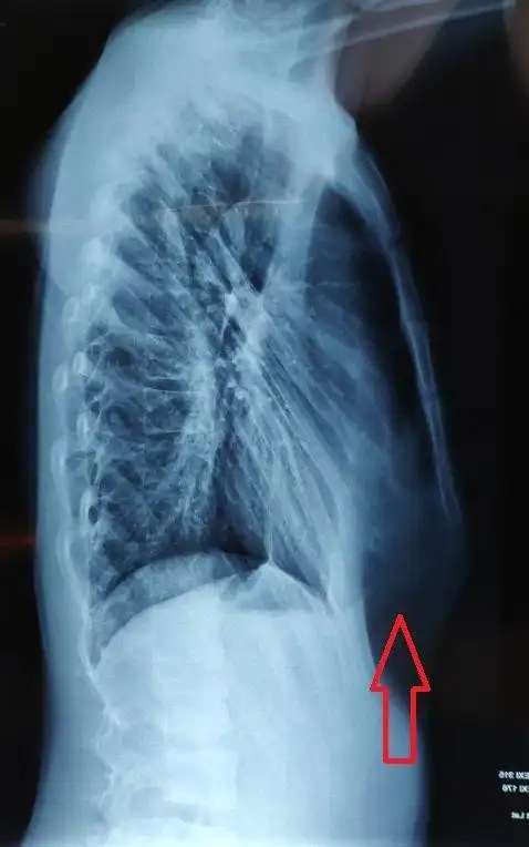 心脏术后复合型胸廓畸形的微创手术 - 好大夫在线