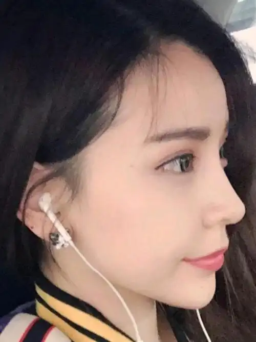 可惜没有天生拥有,在家人的鼓励下去曹家整形做了一个膨体隆鼻,鼻子的