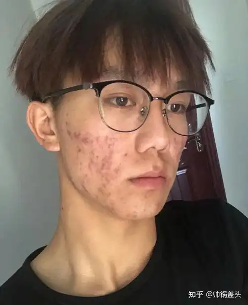 男生满脸爆痘丑的一批麻烦问一下有没有什么好用的祛痘方法急求啊