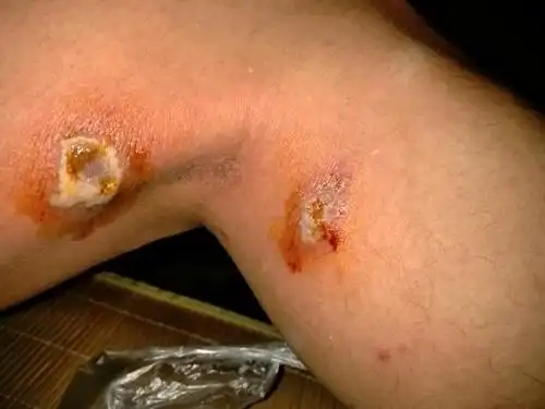 谁帮我看看这是不是蟑螂咬的?