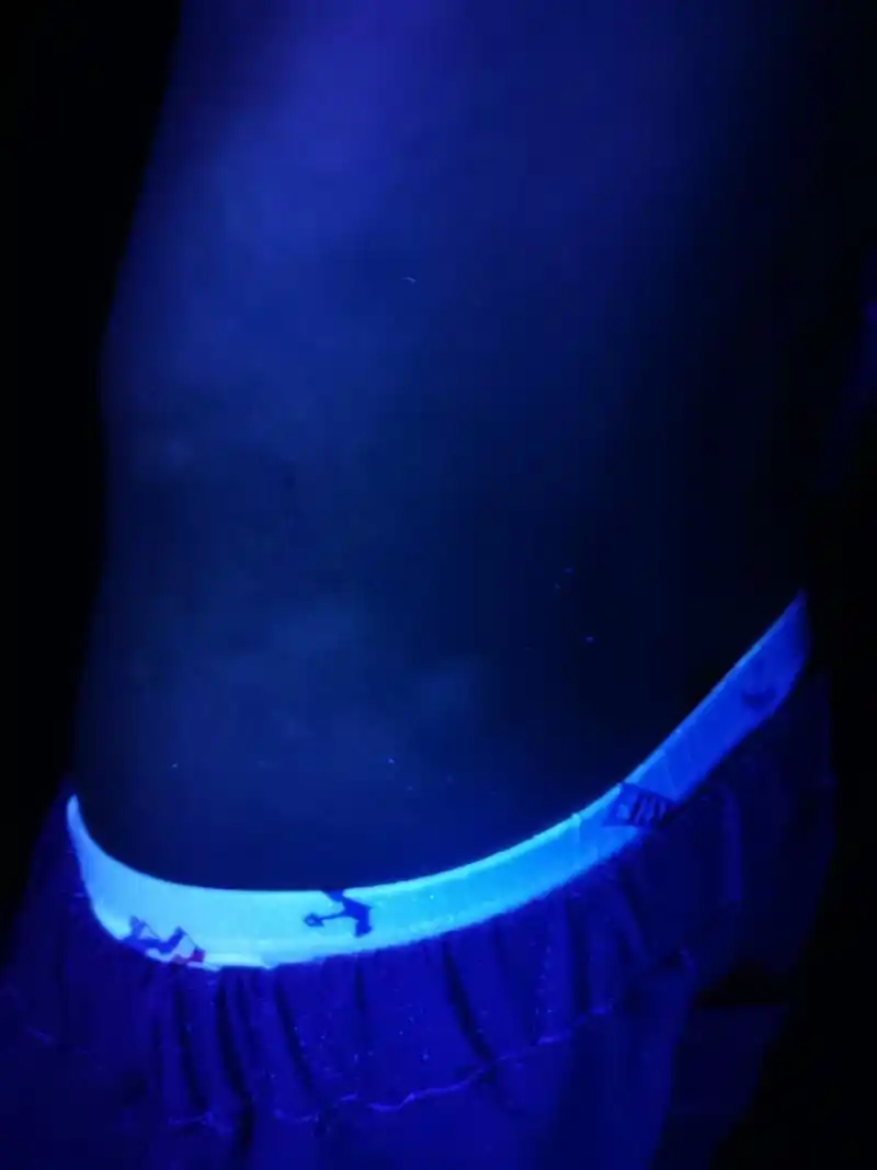 儿子昨天在伍德灯下确诊的白癜风,麻烦大家帮我看看这种斑真的是