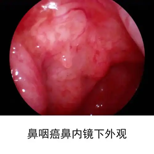 世界范围内鼻咽癌发病率不到1/10万,但在我国高发地区其发病率可高达