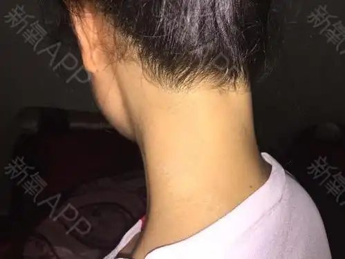 过了大概半个月了吧发际线调整的地方前面毛毛掉的比较_圈子-新氧美容