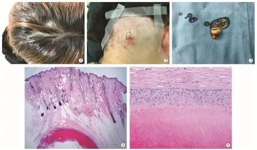 多发性外毛根鞘囊肿 1 例