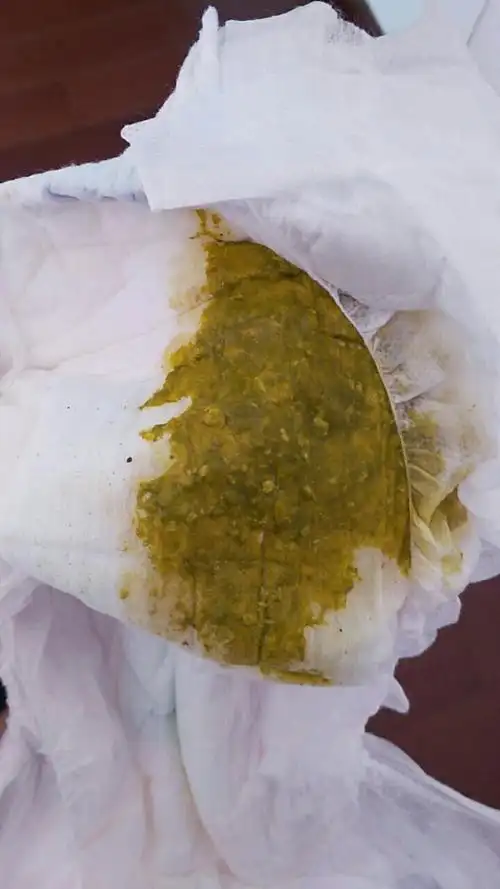 宝宝大便里面有奶瓣是什么原因