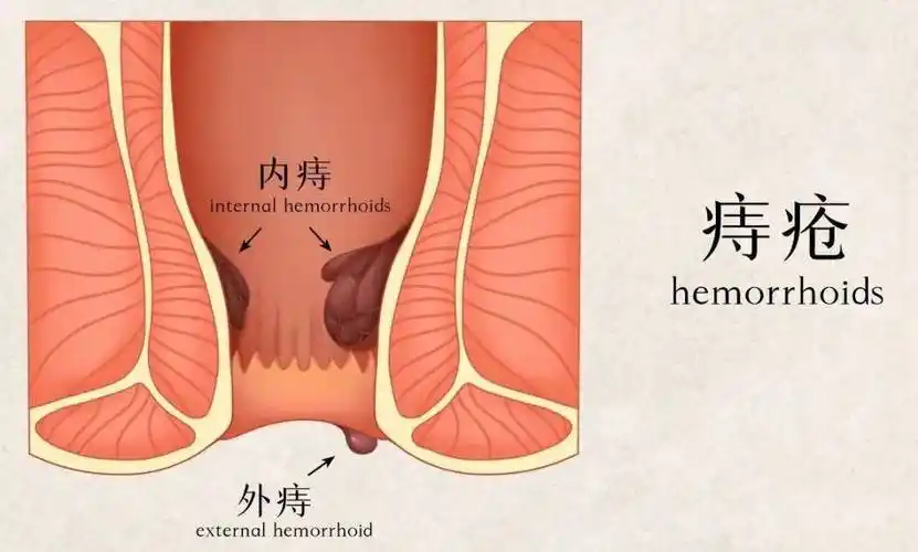 坐上马桶久蹲不起,容易造成肛门直肠内瘀血而引发痔疮疾病