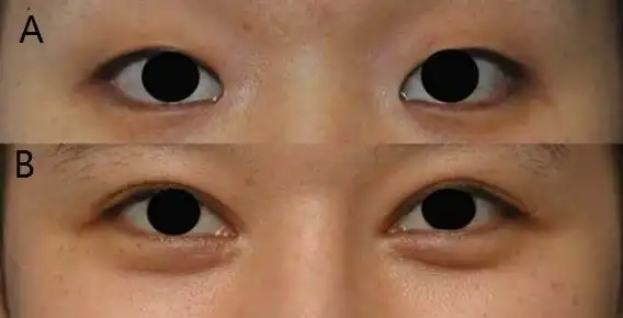 内眦整形:改良 z -成形术矫正内眦赘皮