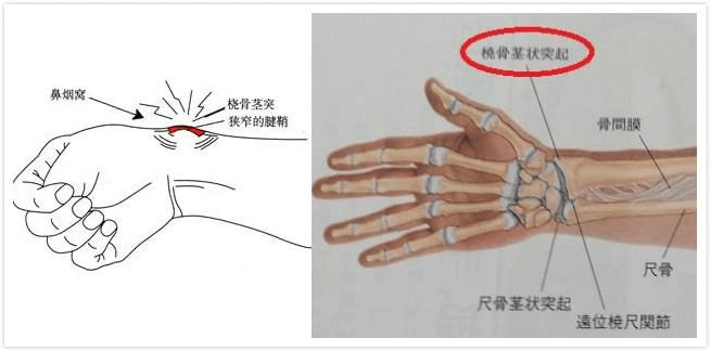 桡骨茎突部狭窄性腱鞘炎(妈妈手)