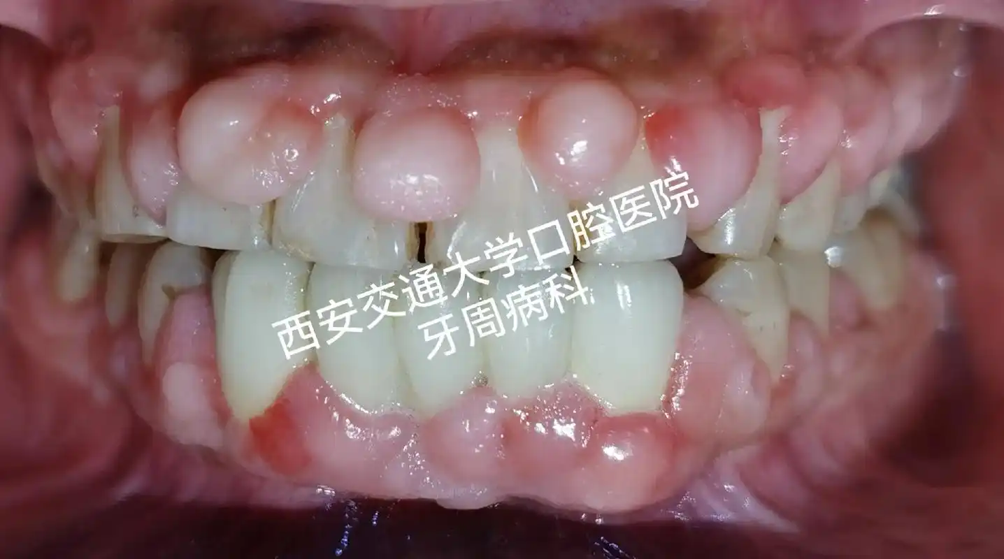 药物性牙龈肥大又称药物性龈增生(drug induced g - 抖音