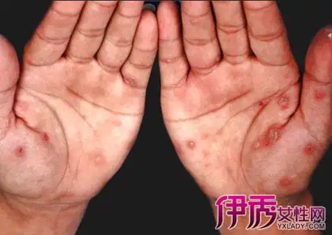 【图】女性梅毒早期症状图片展示 如何预防与治疗