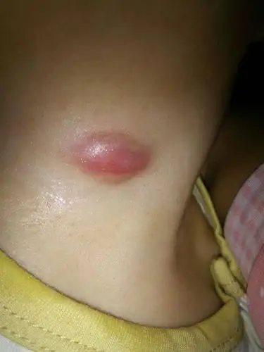 耳朵后边的皮脂腺囊肿图片