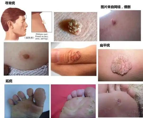 一张图教你辨别疣常见的皮肤疣有哪些
