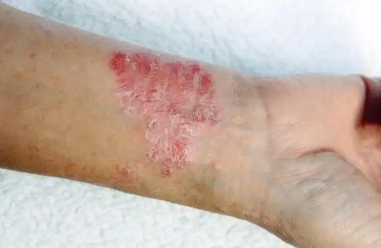 糖尿病与哪些皮肤状况有关系(上)