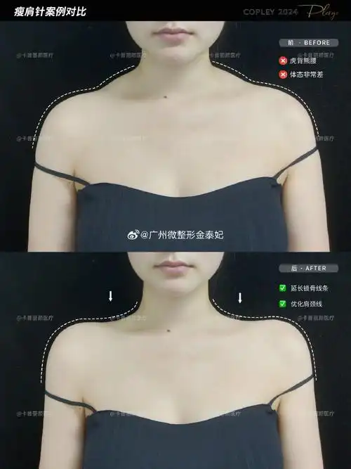 瘦肩针案例对比效果抽空打个瘦肩针吧有种瘦10斤的感觉还你一个长