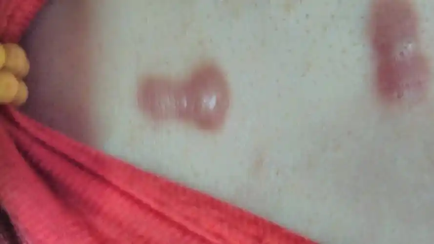 胸前(双乳中间位置)长这样的疙瘩,有什么办法去除!