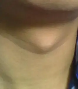 青春发育期男孩子的喉结正常示意图