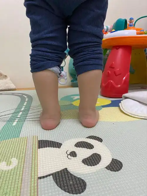 宝宝足外翻怎么办