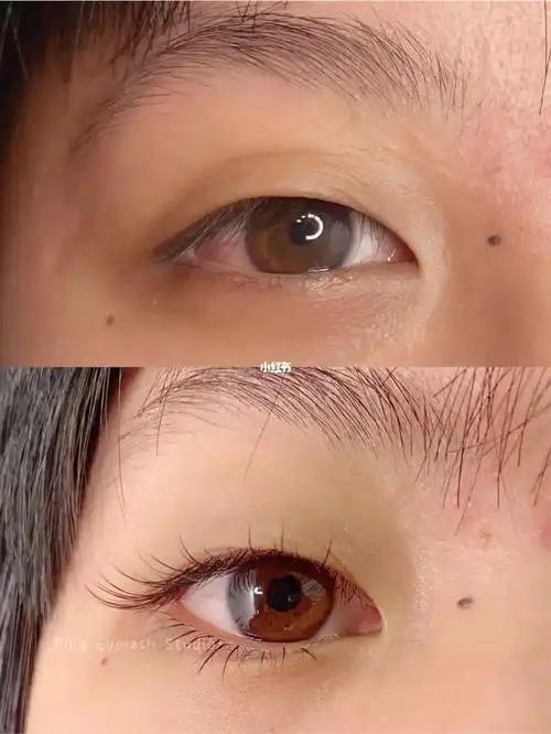 单眼皮嫁接睫毛前后眼睛变化好多
