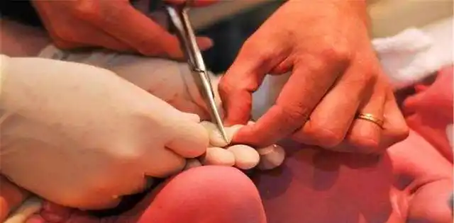 医生拿剪刀逼近,新生宝宝拔腿落跑,网友:剪脐带时宝宝也会痛吗