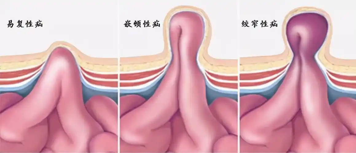小儿疝气科普 ▏孩子肚子上起包块,腹腔镜手术无创修补|小儿腹股沟疝
