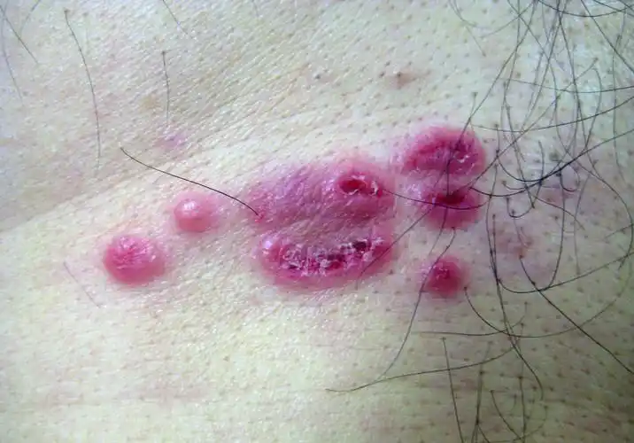 皮肤性白血病(局部型)