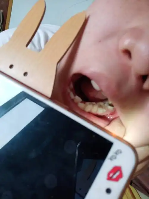 牙根长个红色的小肉疙瘩,好久都不下去!