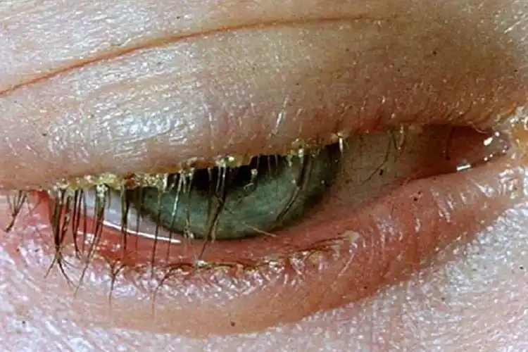 眼睑炎的症状图片_有来医生