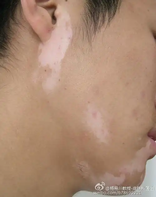 这个是白癜风吗? 2.是不是需要具体确诊白斑的起因才可