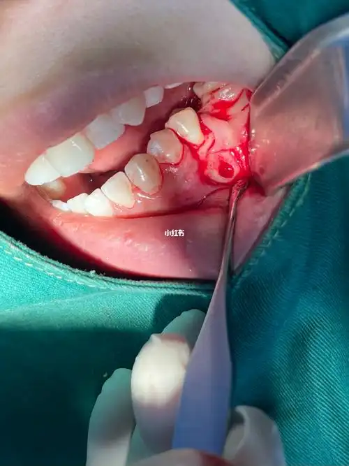 根尖囊肿顾名思义牙根根下面因为发炎长出囊肿前期先做根管治疗体积较