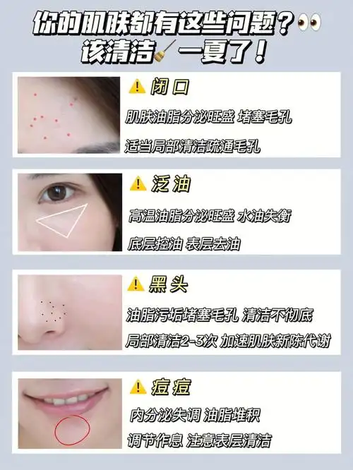 夏季出油黑头毛孔堵塞有这一瓶就够了