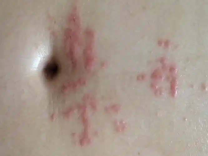 几天前我的肚脐(三四天前)附近起了几个小疙瘩,非常痒,忍不住一直抓