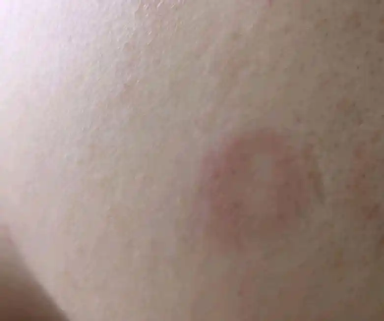 脸上突然长了个"圆圈状红斑",到底是咋回事?看医生怎么说!