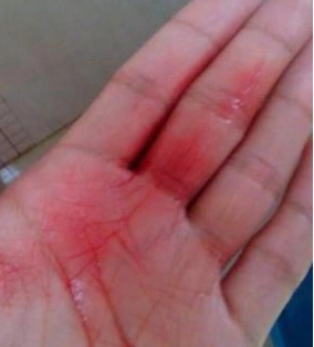 62岁男子一天两包烟,咳嗽见血,医生说有癌症,却不是肺癌