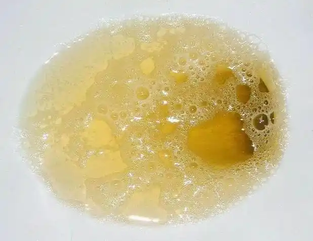 正常人的尿泡沫图片